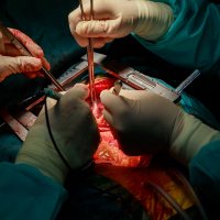 Suture of an lung emphysema surgery in an infant andmedical assistance close-up :: Valentyn Semenov
