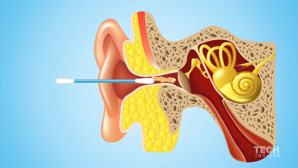 Полезные советы. Вот почему вам не следует чистить уши ватными палочками